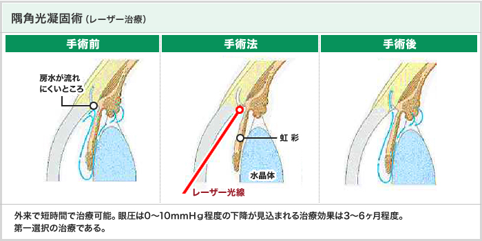 隅角光凝固術（レーザー治療）