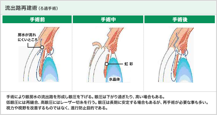 流出路再建術（ろ過手術）